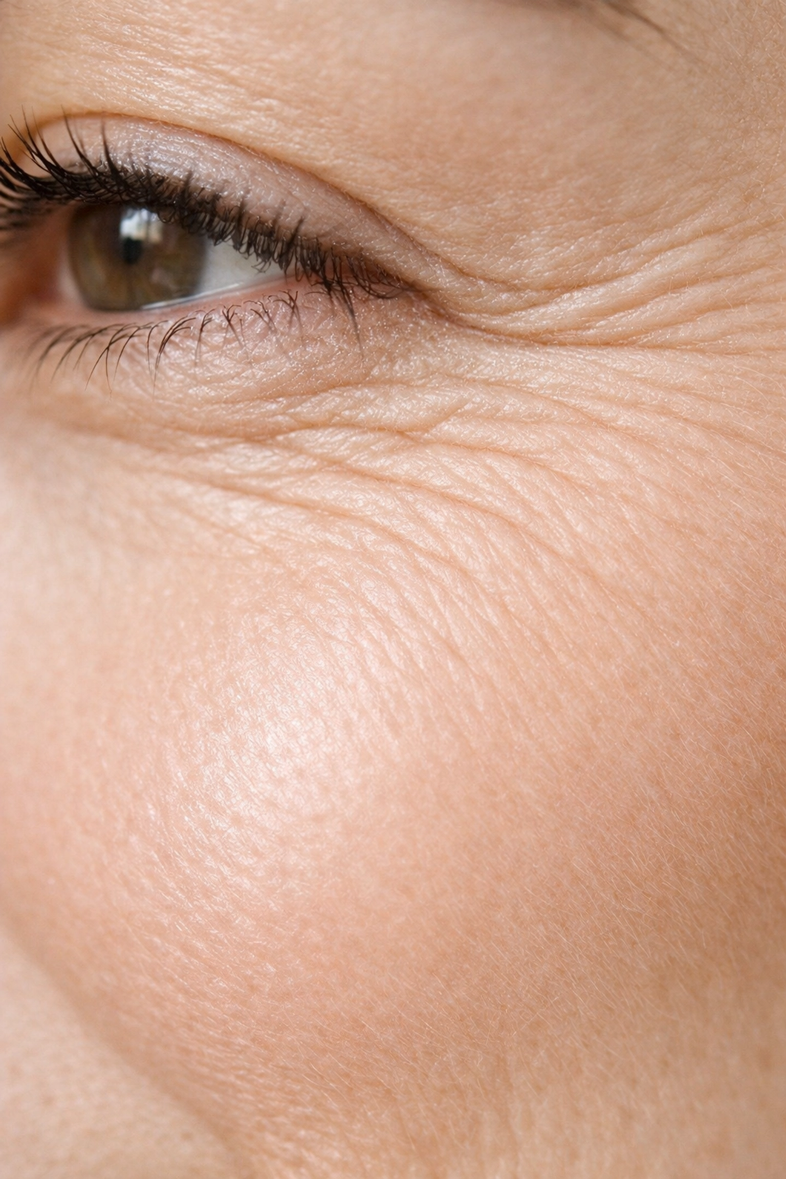 Fine lines and wrinkles under eyes demonstrating area treatable with wrinkle reduction injections