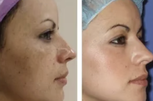 Side-by-side Skin Improvement Photos