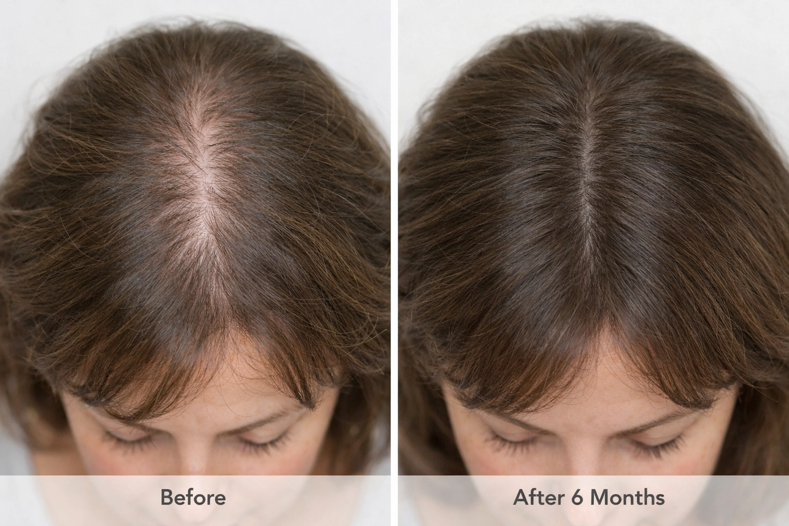 Before and after results showing improved hair density from red light therapy treatment over six months
