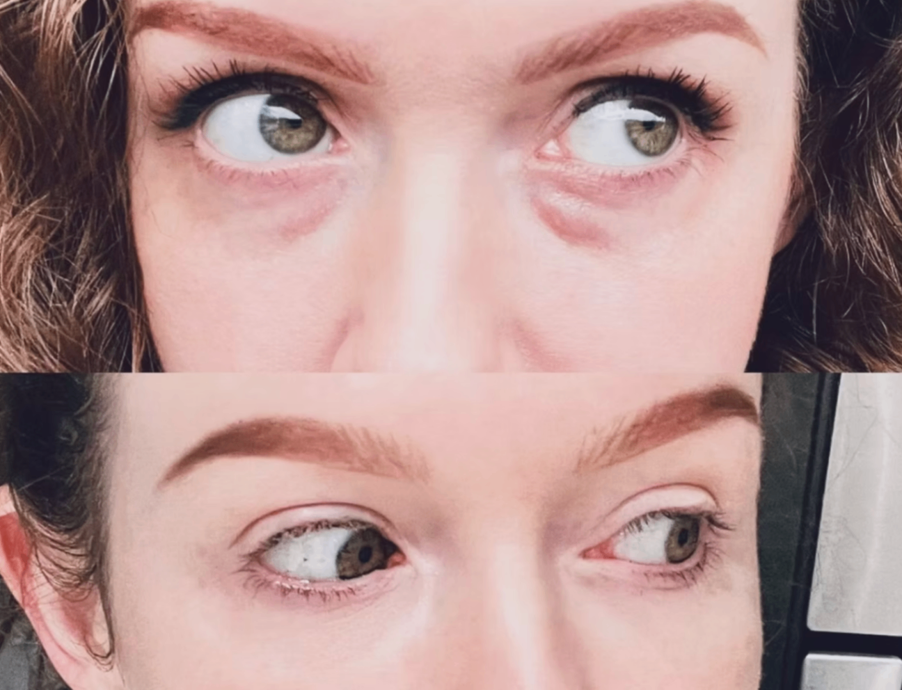 Tear Trough Rejuvenation Before & After