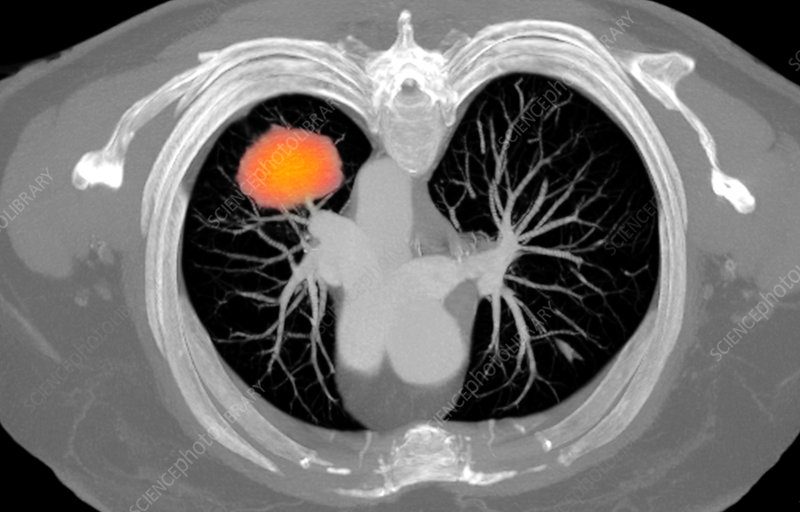 lung cancer screening Rockford IL patient low dose CT scan