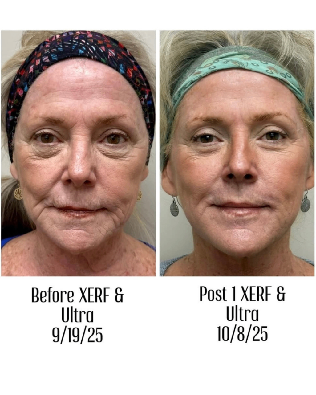 XERF & Ultra Treatments Before and After