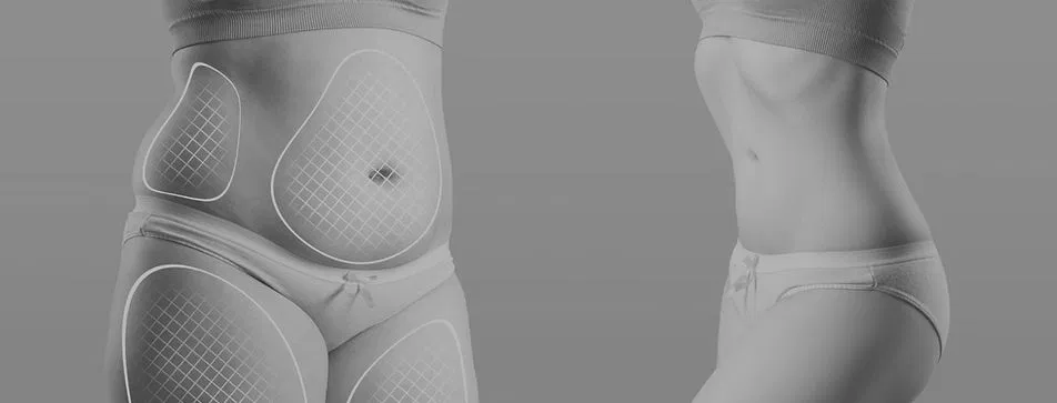 body-contouring-before-after-marked-treatment-zones.webp