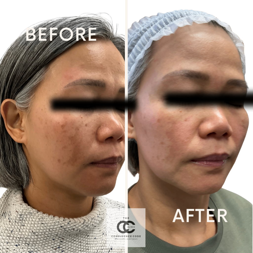 Skin Rejuvenation Treatment Improvement