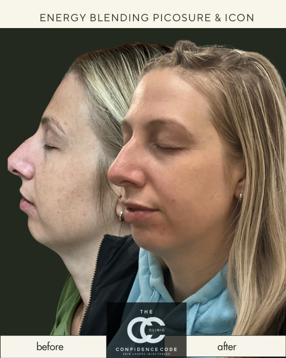 Energy Blending Picosure & Icon Laser Treatment - Before and After