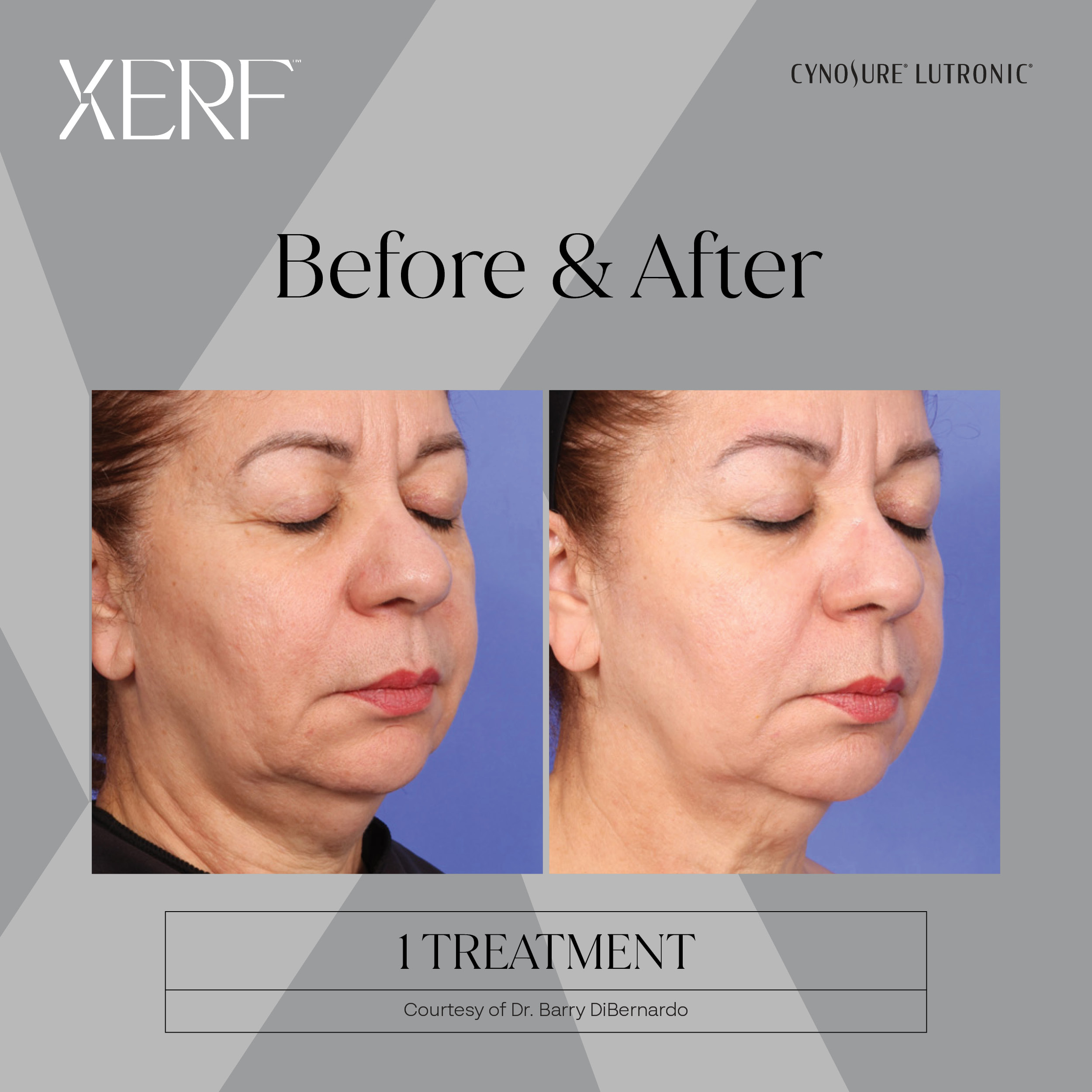 Skin Tightening Before and After