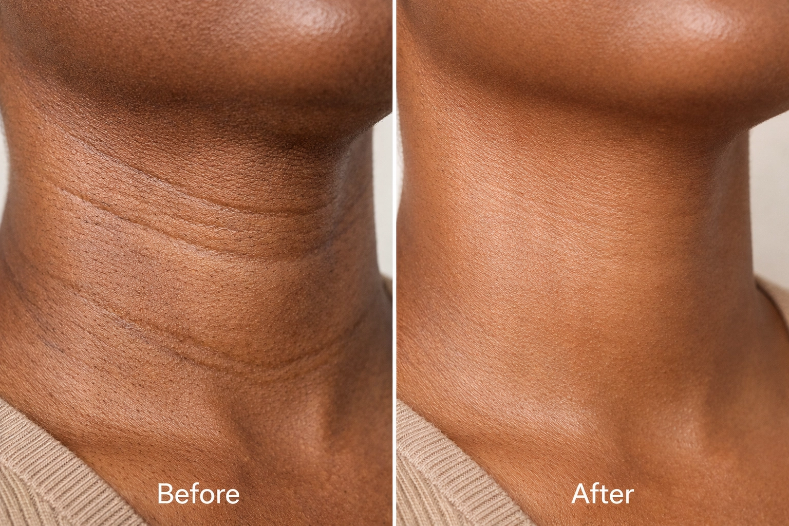Before and after comparison of neck skin showing reduced tech neck lines and improved tone on melanin-rich skin