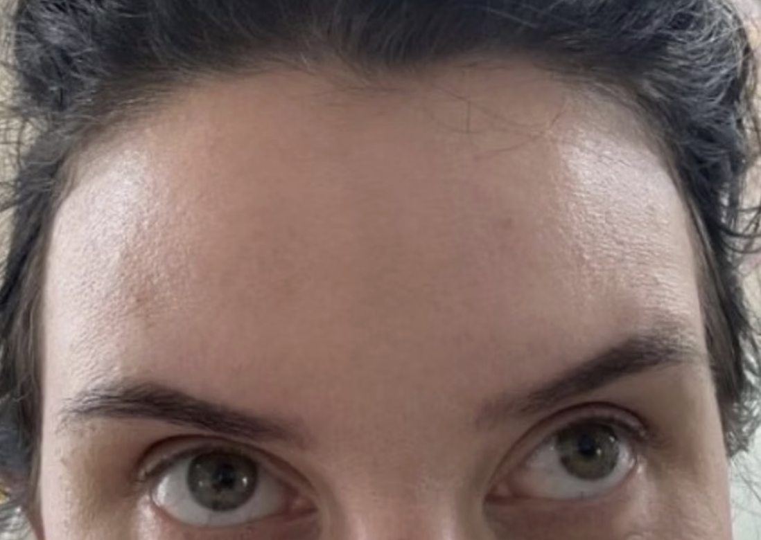 Forehead After Aesthetic Treatment