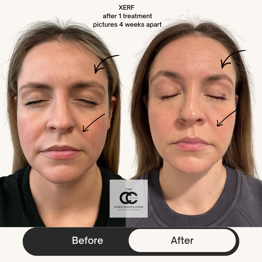 XERF Skin Treatment Before and After