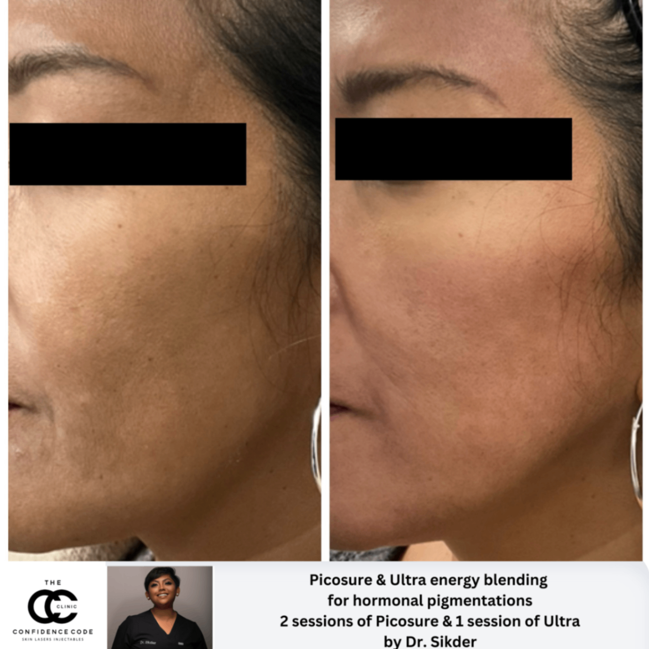 Reduction in Hormonal Pigmentation - Before and After