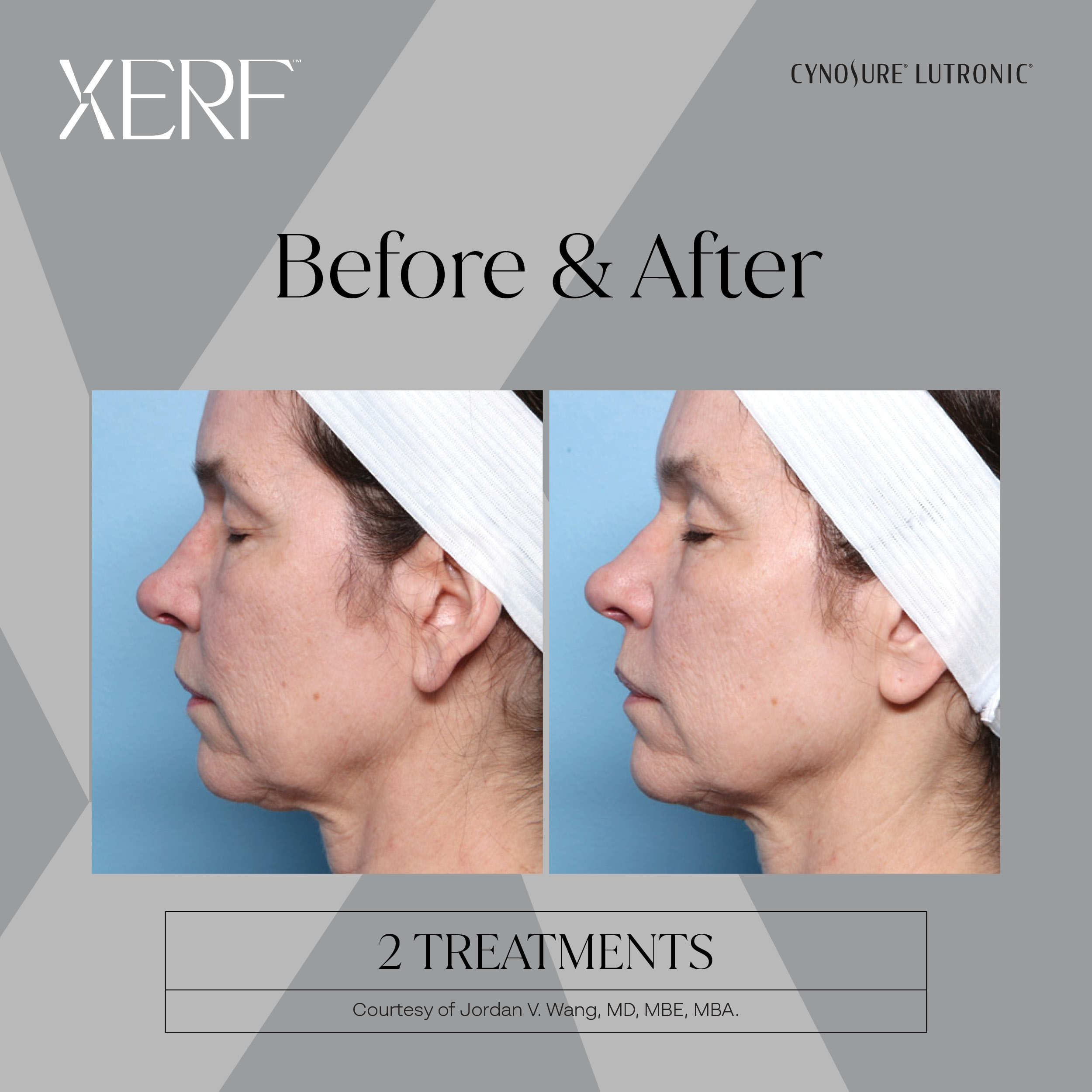 Non-surgical Skin Tightening Profile Transformation