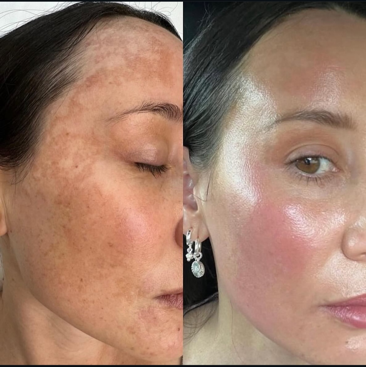 Melasma Treatment Before and After