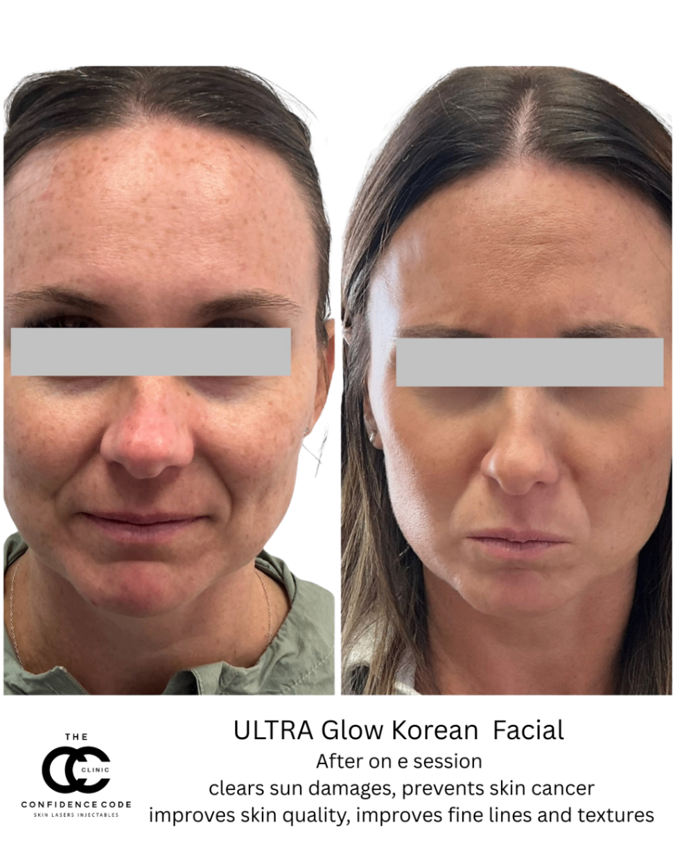 ULTRA Glow Korean Facial Before & After