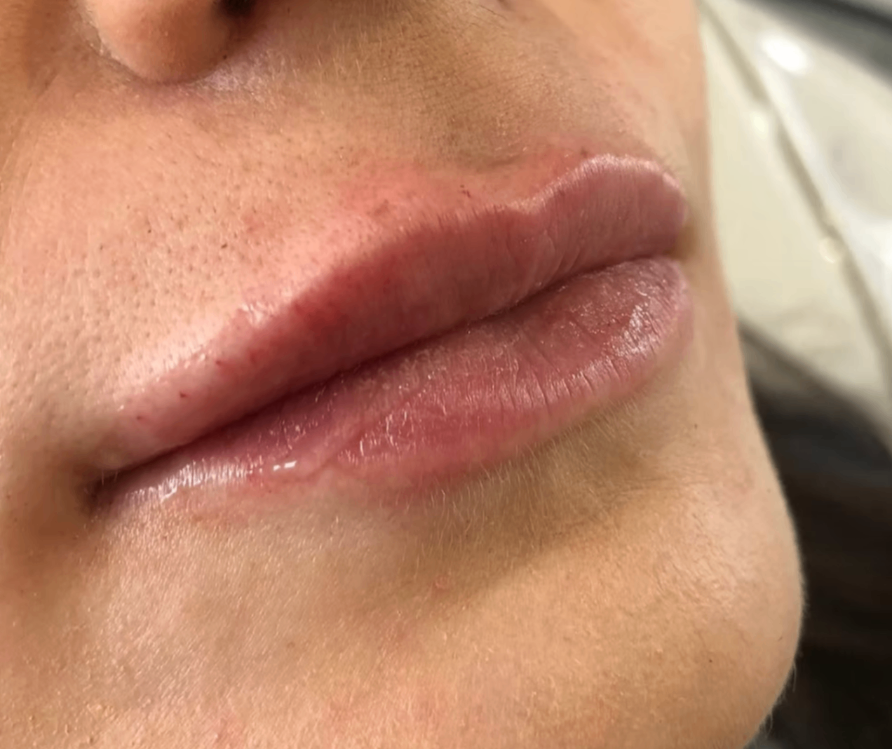 Freshly Treated Lips After Dermal Filler at Bella Medica Aesthetics