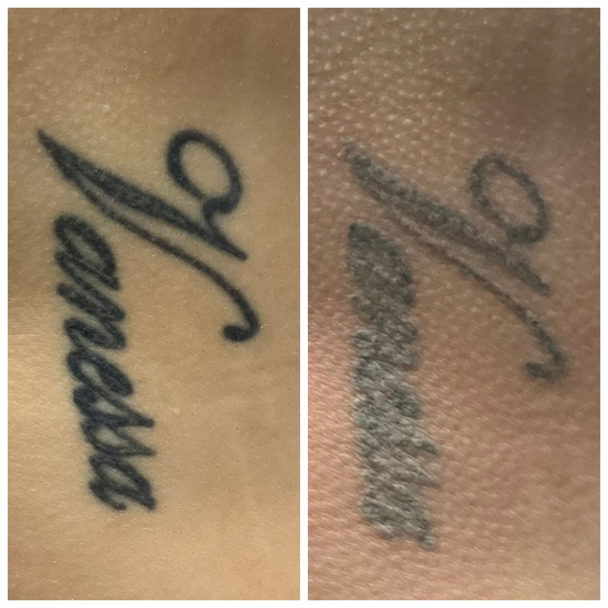 Tattoo Removal Progress Comparison