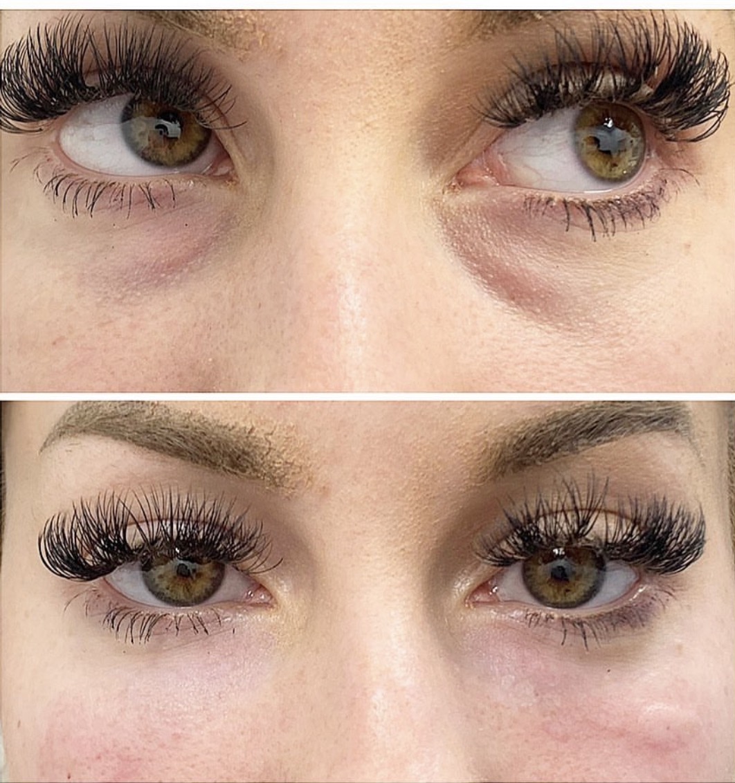 Under-eye filler treatment before and after The top image shows visible hollowing and dark circles, while the bottom image demonstrates smoother, fuller under-eye contours with significantly reduced shadowing for a refreshed, youthful appearance.