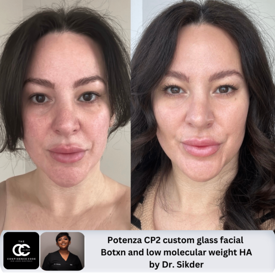 Potenza CP2 Custom Glass Facial Before and After Images