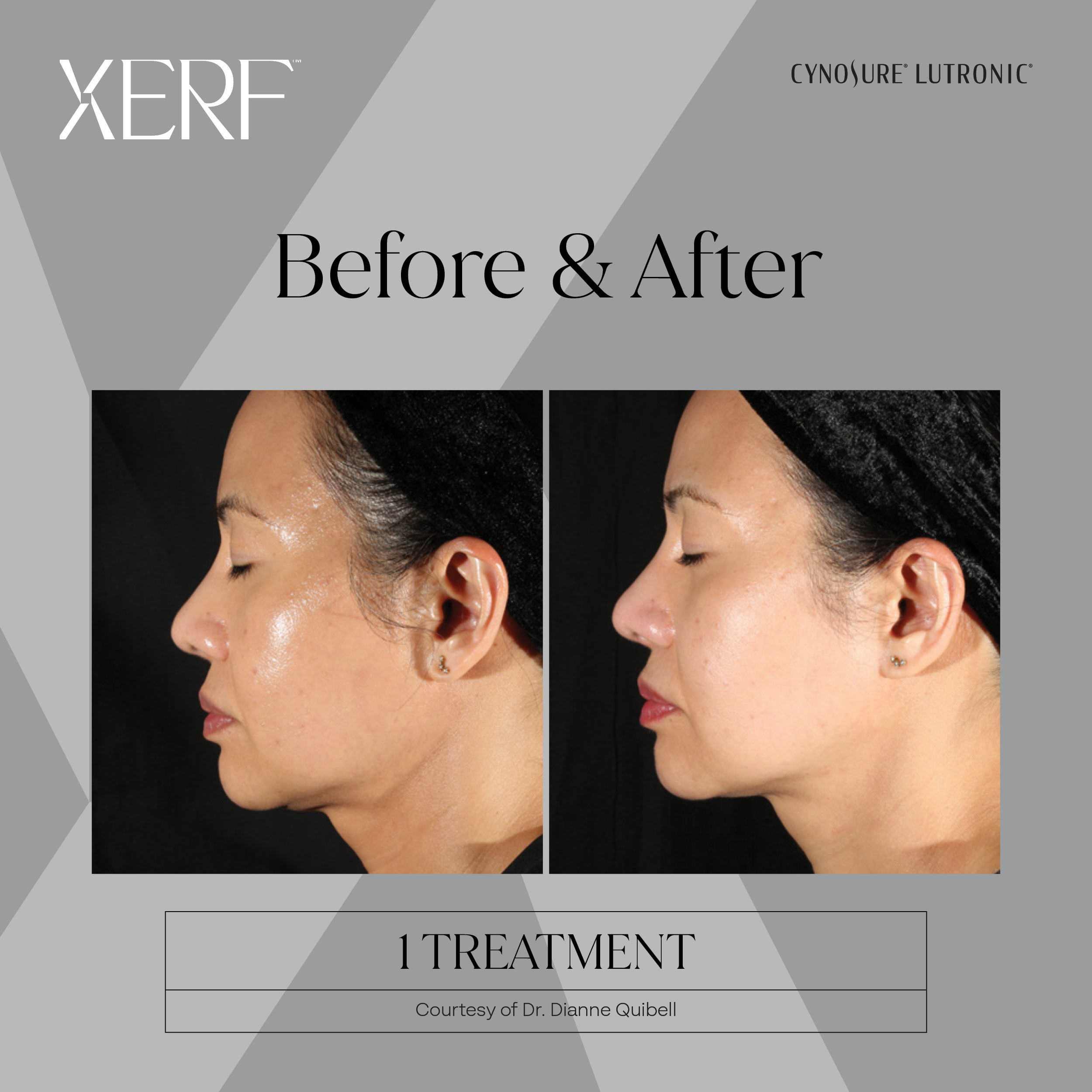 XERF Treatment Before and After