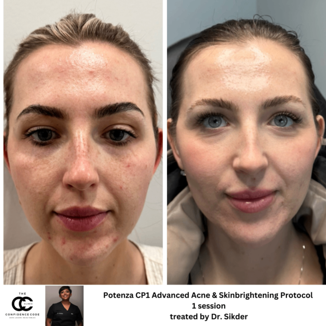 Potenza CP1 Advanced Acne & Skinbrightening Protocol Before and After