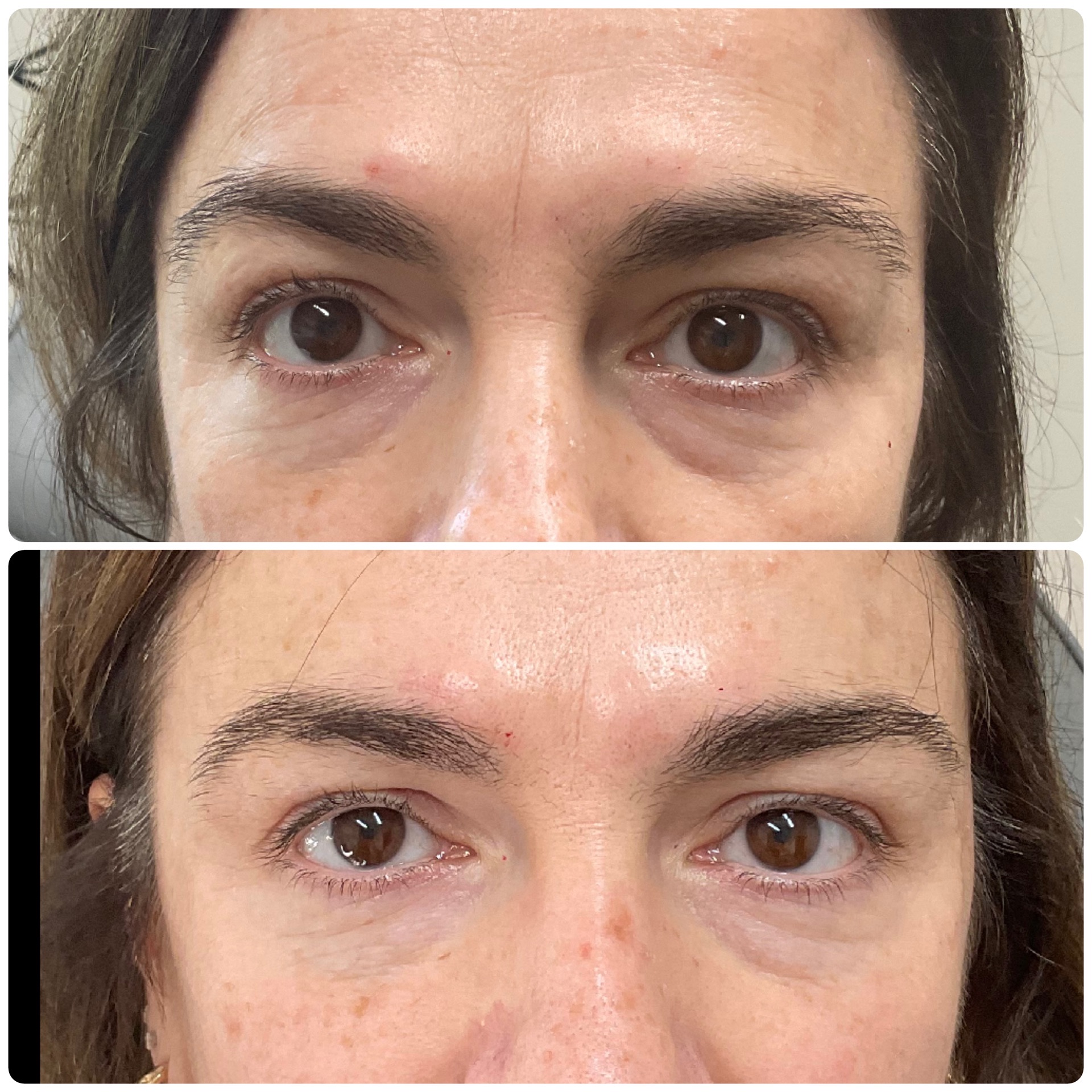 Before and After Eye Area