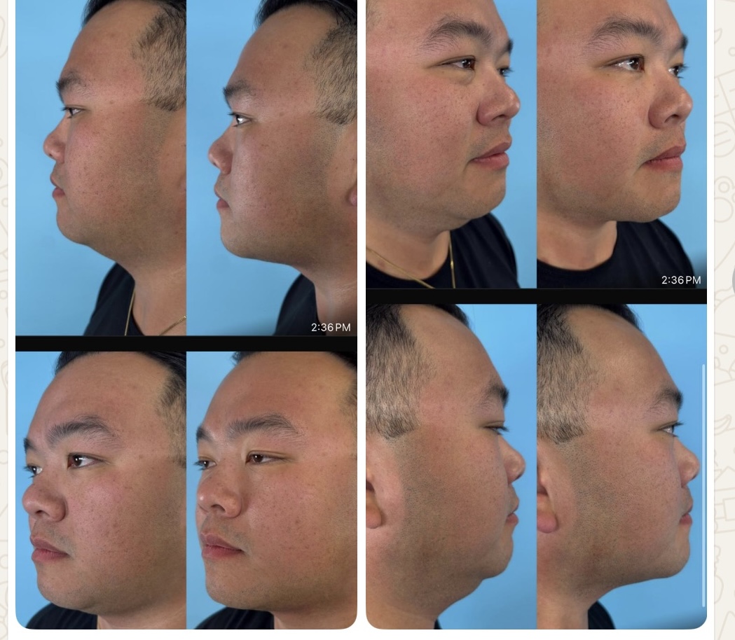 Male Jawline and Chin Definition Before-and-After
