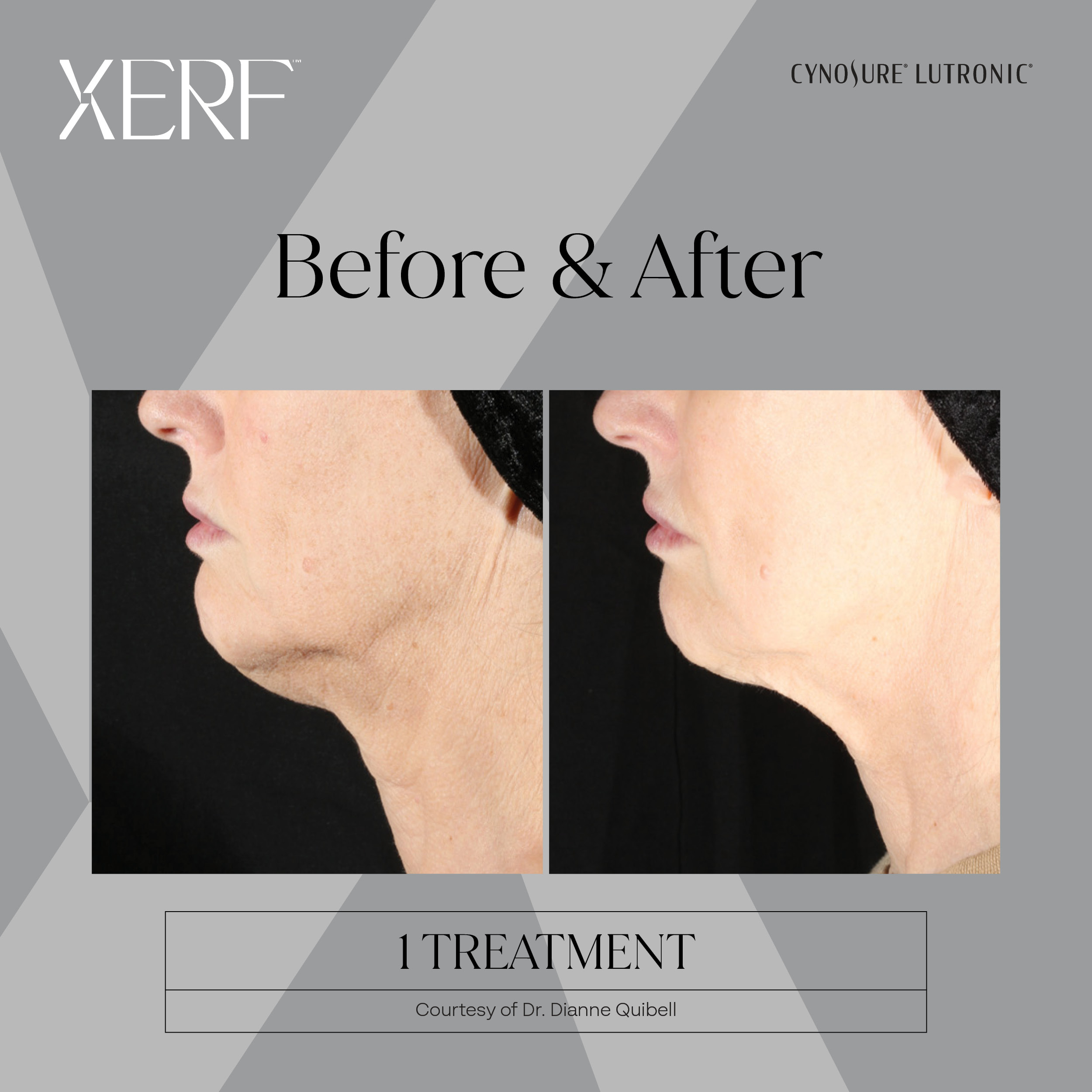 Lower Face and Jawline Skin Tightening