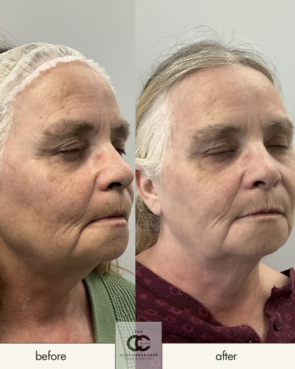 Non-Surgical Skin Rejuvenation and Filler Results