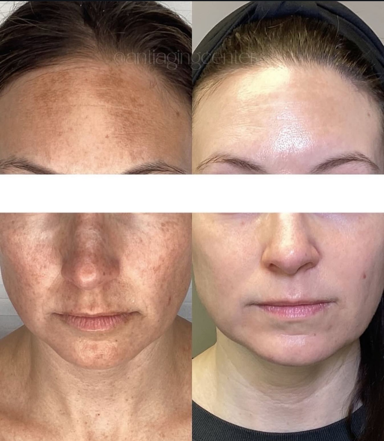 Pigmentation Correction Before-and-After