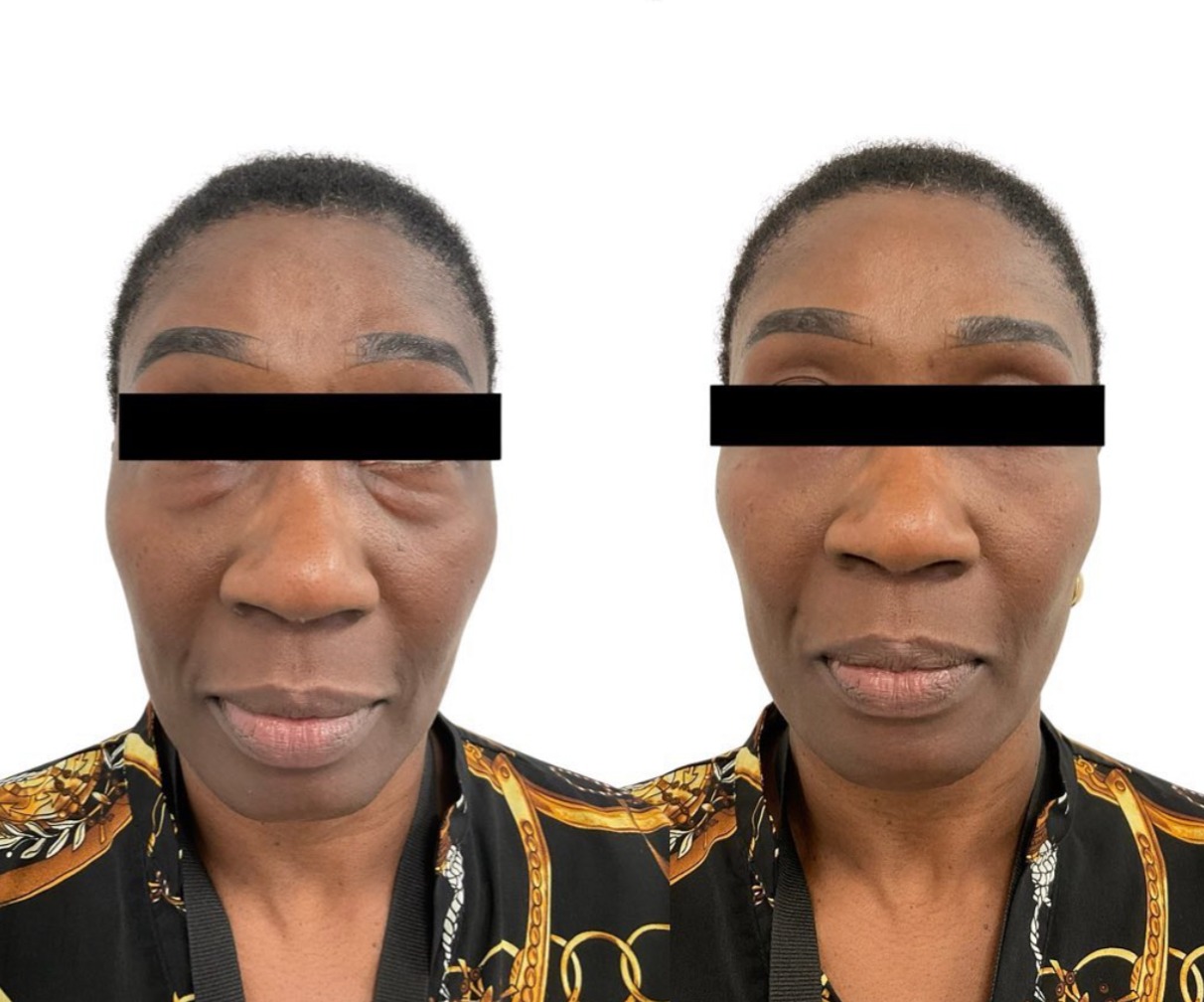 Before-and-after under-eye treatment at The Confidence Code Clinic Before-and-after photo showing significant reduction of under-eye puffiness and smoother skin texture following a non-surgical treatment, demonstrating natural-looking rejuvenation performed at The Confidence Code Clinic.